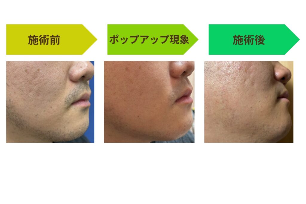 髭脱毛で起こるポップアップ現象とは