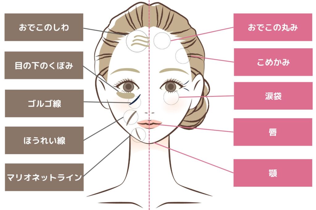 ヒアルロン酸注射(注入)の部位・効果