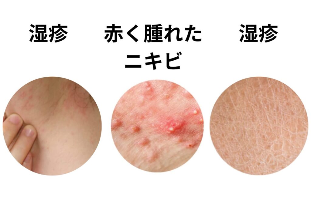 皮膚の炎症や乾燥がひどい人