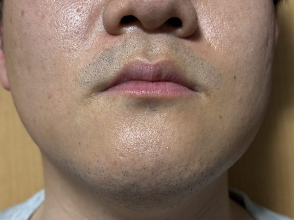 ヒゲ脱毛アフター