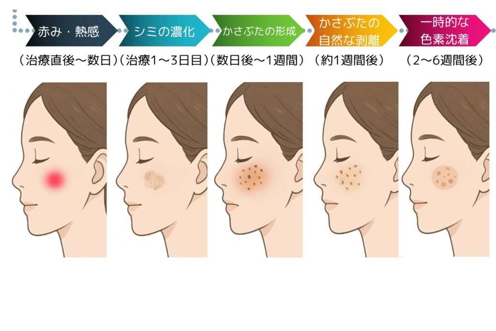 シミ取りレーザー治療後に肌で起こる変化とは?