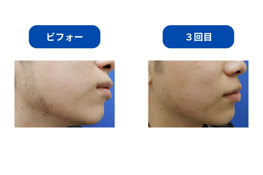 1~3回|毛量や生える速度に変化を感じ始める