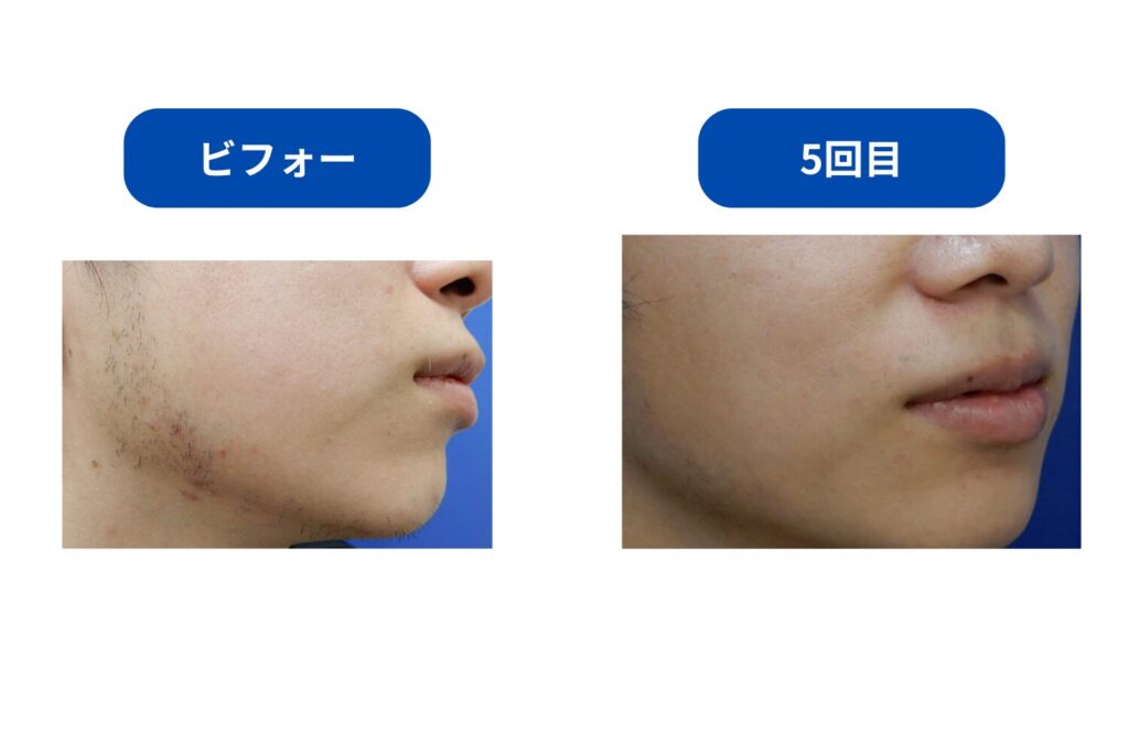 5回前後|髭が薄くなり自己処理が楽になる