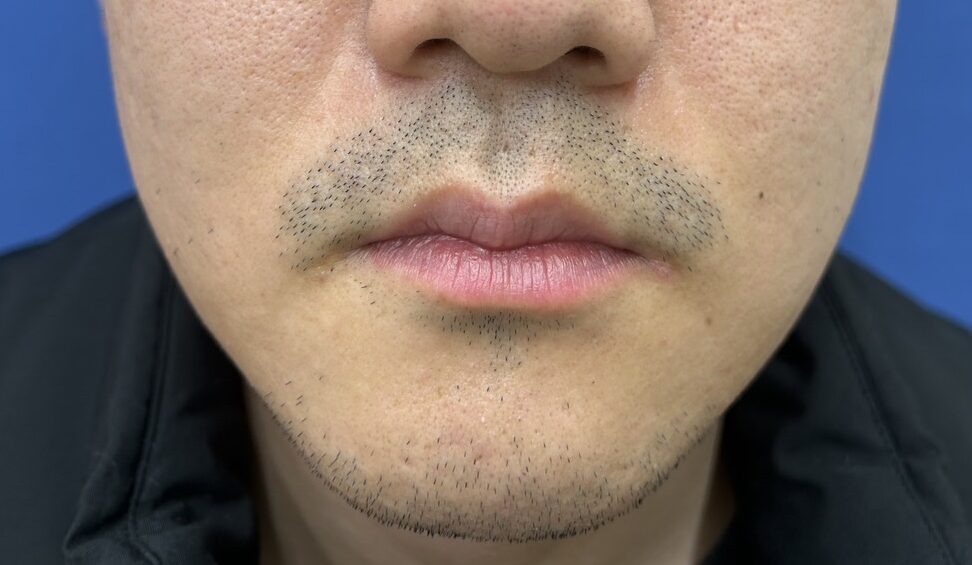 ヒゲ脱毛ビフォー