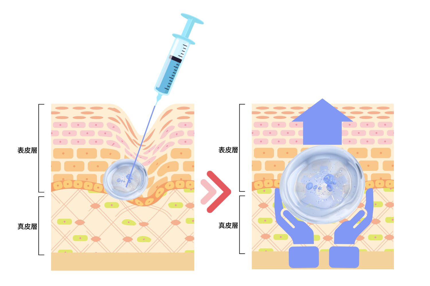 ヒアルロン酸注射(注入)の作用と仕組み