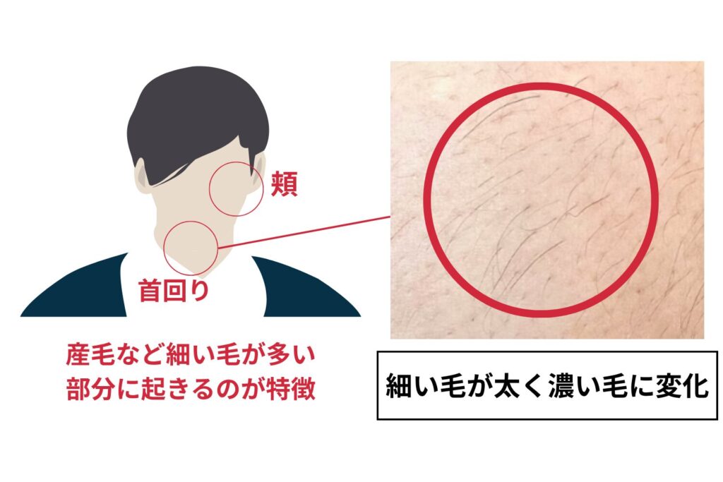 硬毛化