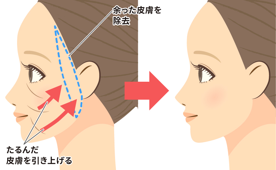 フェイスリフトの効果