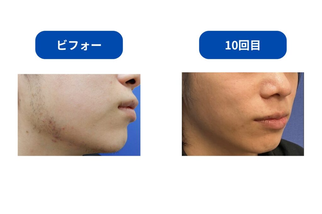 10回以上|ツルツルに近い状態を目指せる