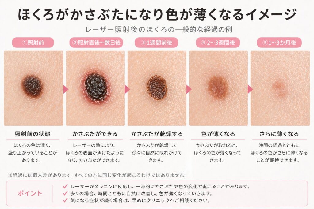 かさぶたになり色が薄くなることがある