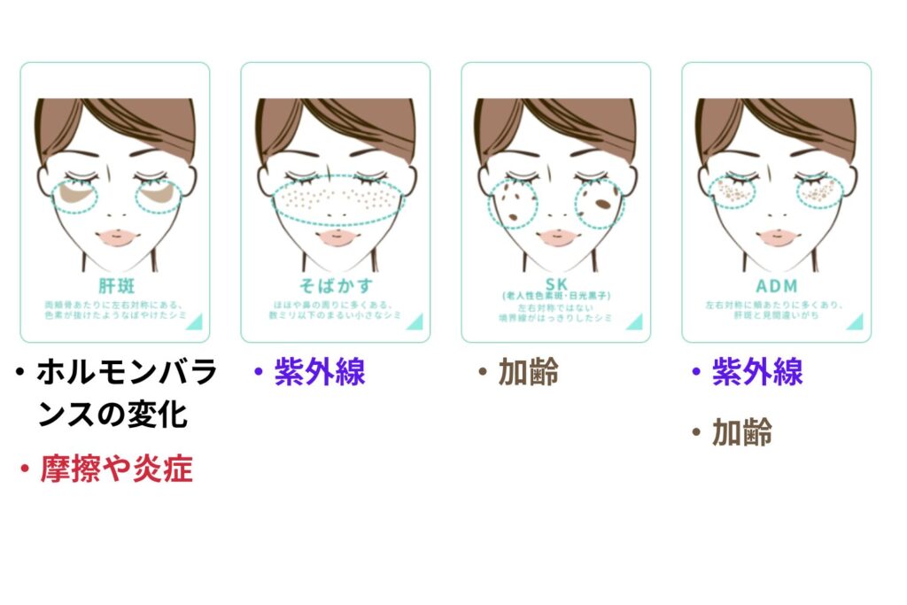 代表的なシミの種類と見分け方【症状・原因・特徴】