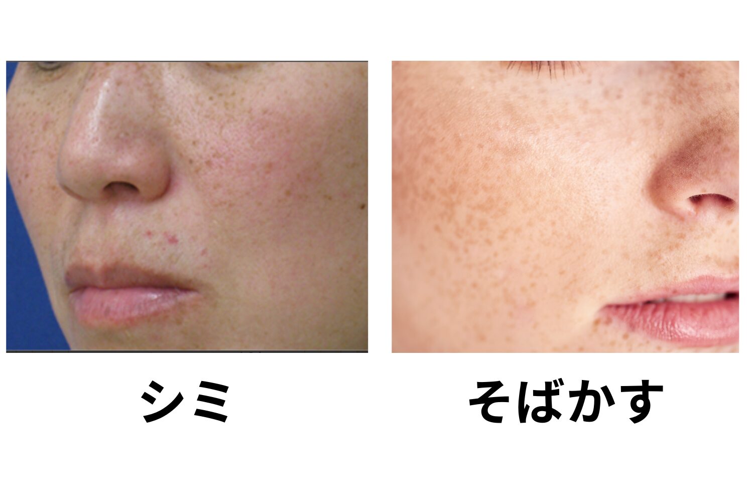 そばかすとシミの違いを徹底解説｜原因・見分け方・効果的な予防と治療法 - ハートライフクリニック（静岡県浜松市の美容皮膚科・美容外科）