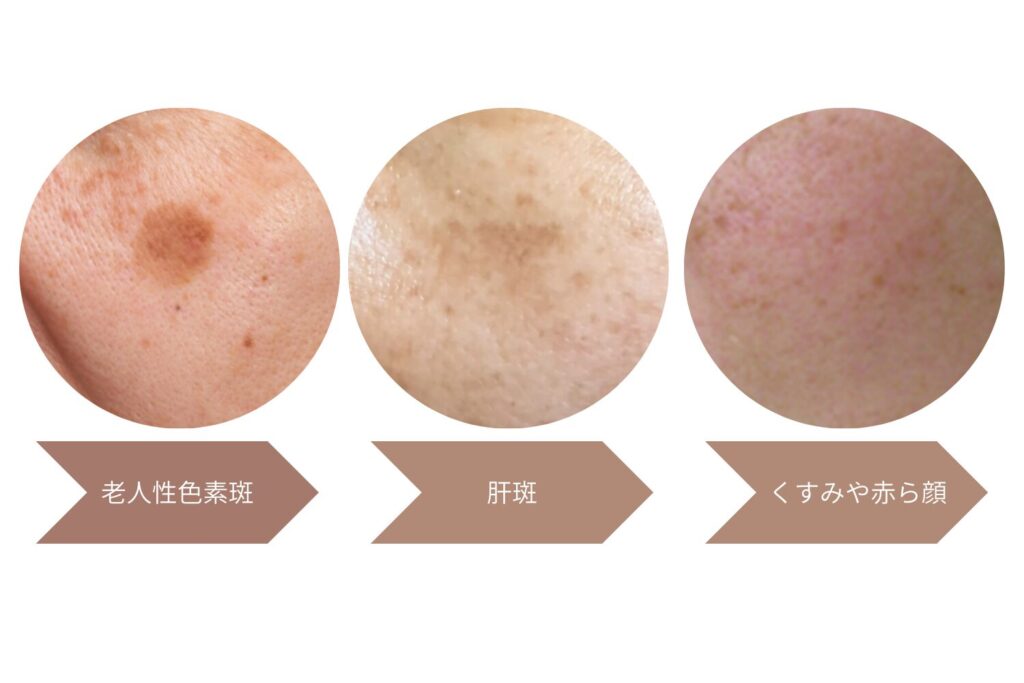 シミの種類別おすすめ治療法と費用
