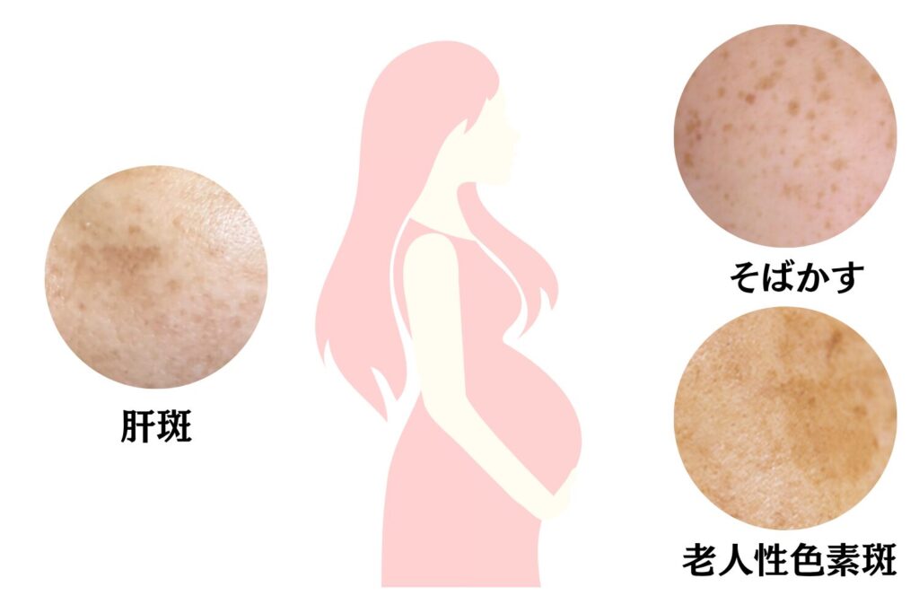 産後にできやすいシミの種類と特徴