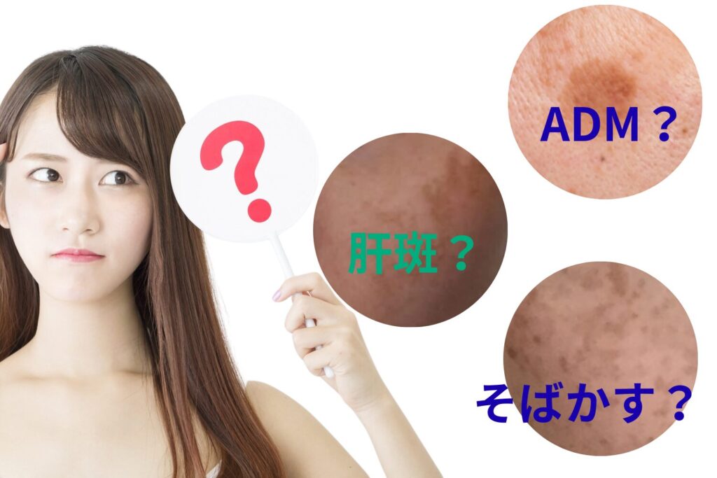 【最新】シミ取り治療の種類と選び方｜レーザー・光治療・内服薬...