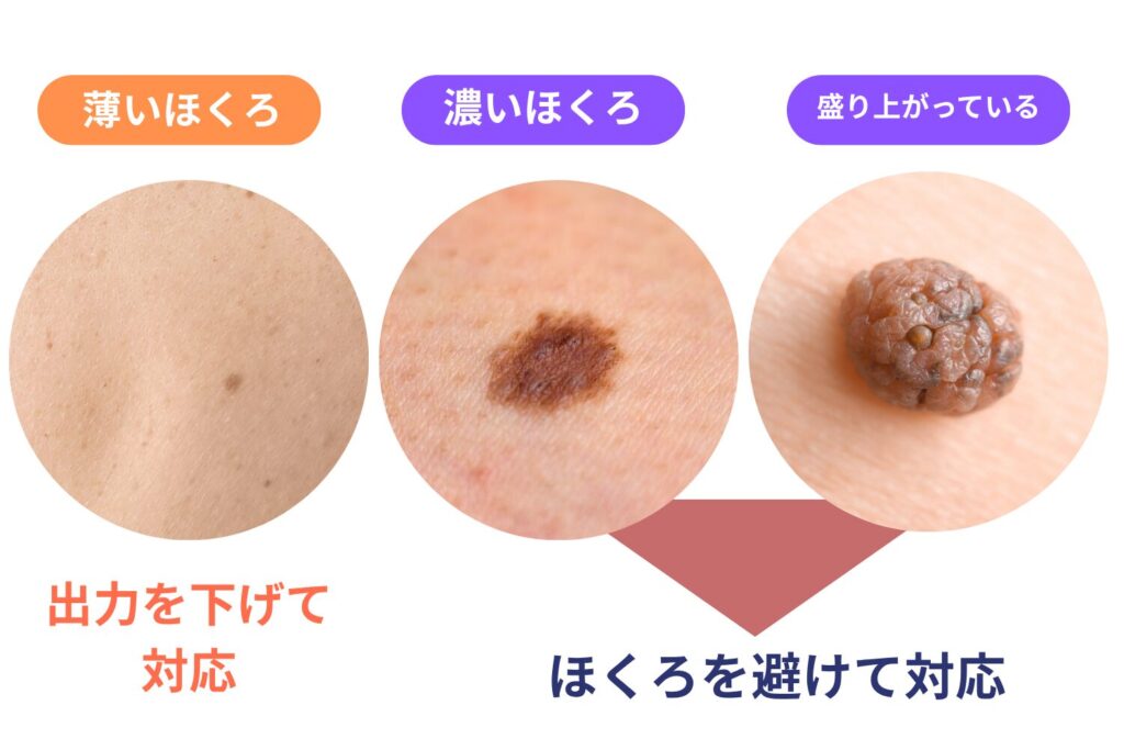 薄いほくろと濃いほくろで対応が異なる