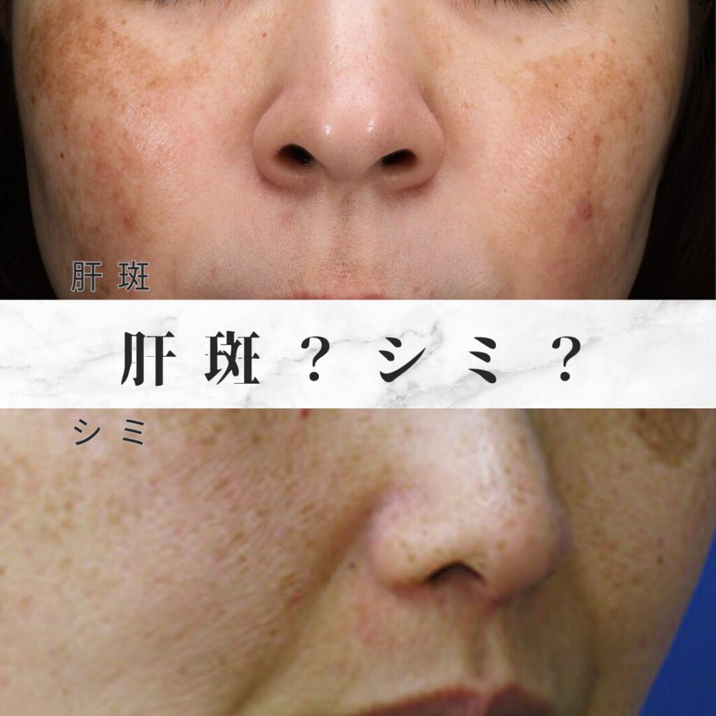  シミと肝斑の違いを徹底解説｜原因・見分け方・効果的な治療法...