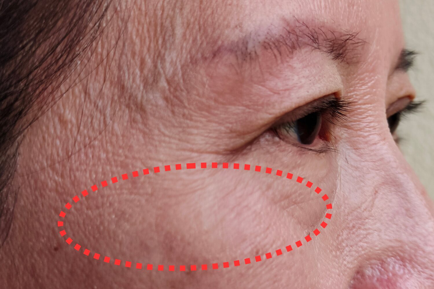 目の下のシミ原因と対策|種類別の特徴・消す方法・予防法を徹底解説