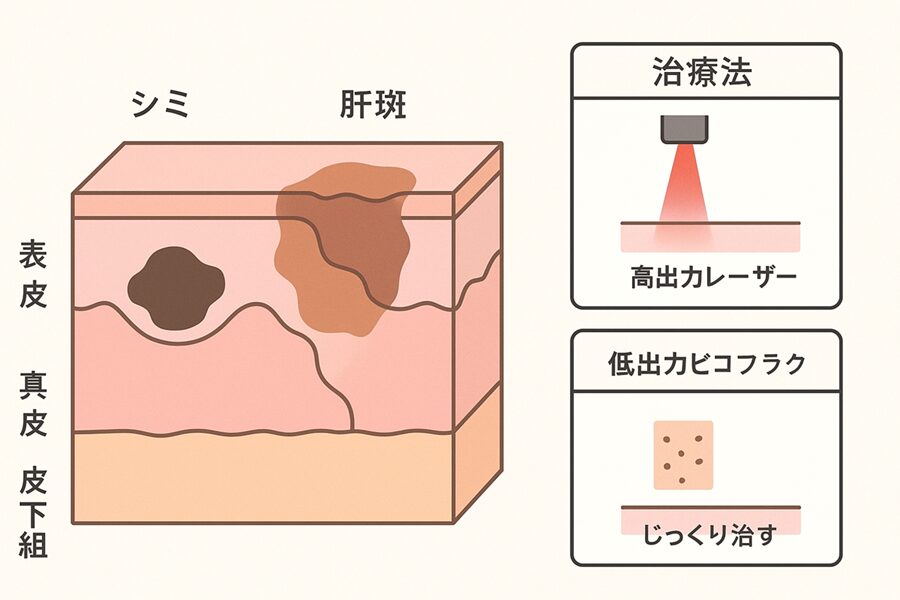 肝斑とシミの治療法はなぜ異なるのか