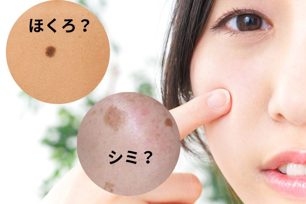 シミとほくろの違いを徹底解説｜見分け方・原因・治療法まで専門...