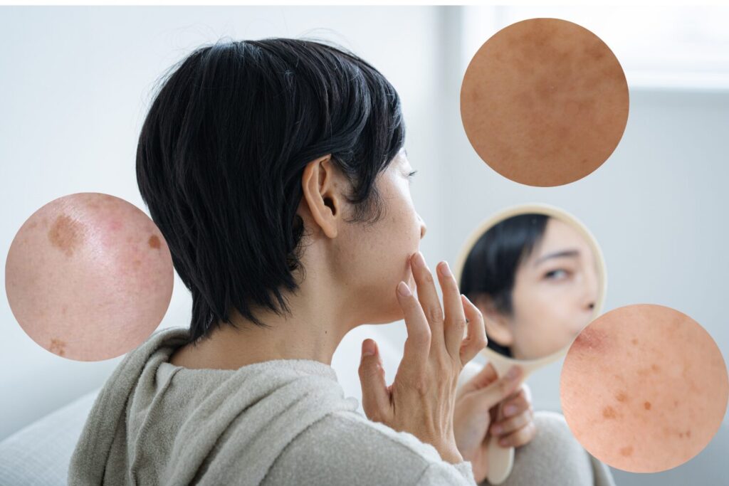 シミの種類と見分け方｜原因別の特徴・治療法・予防法を徹底解説