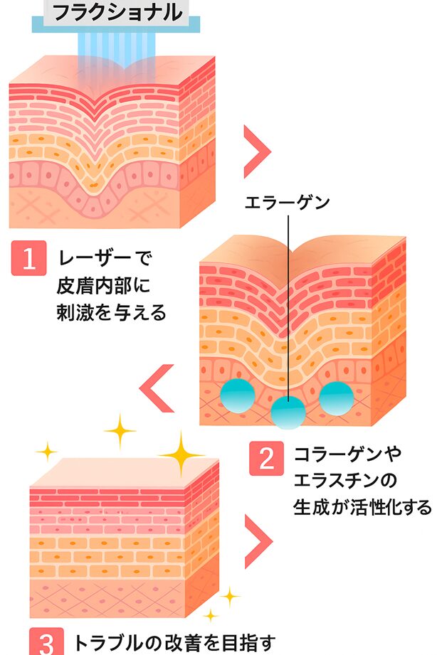 ピコフラクショナル