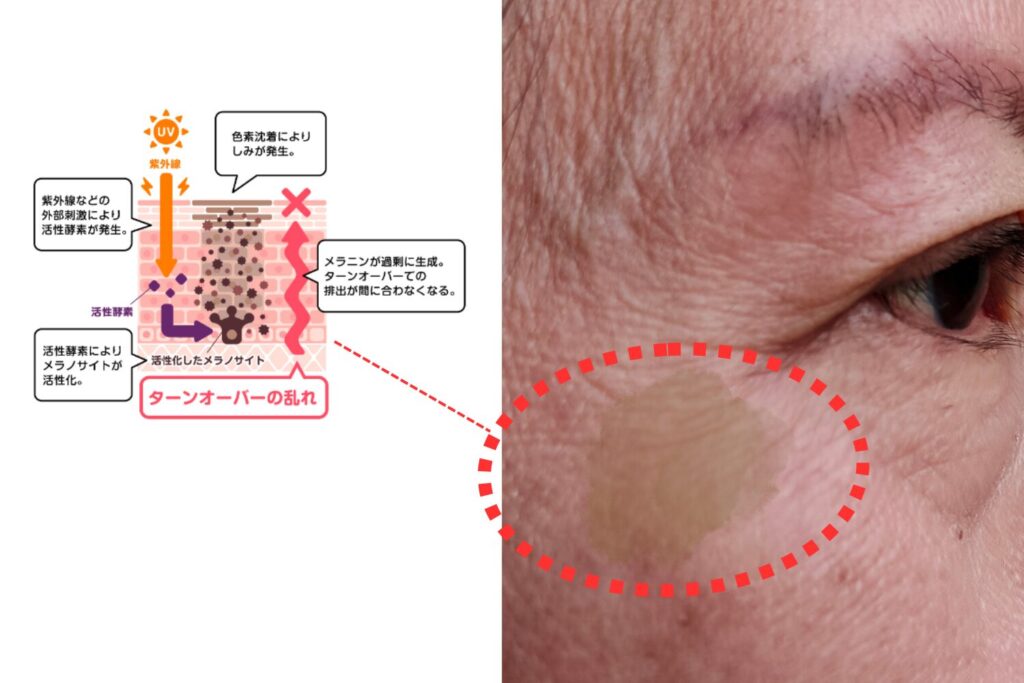 目の下にできるシミとは？その原因と特徴を理解する
