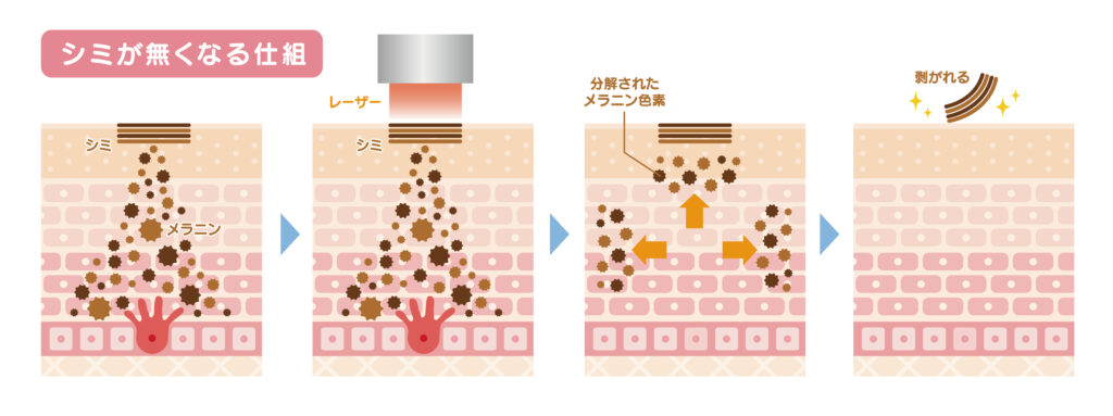 シミ取りレーザーとは?仕組みと他の治療との違いを理解しよう
