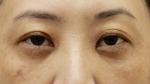 くまとりアフター