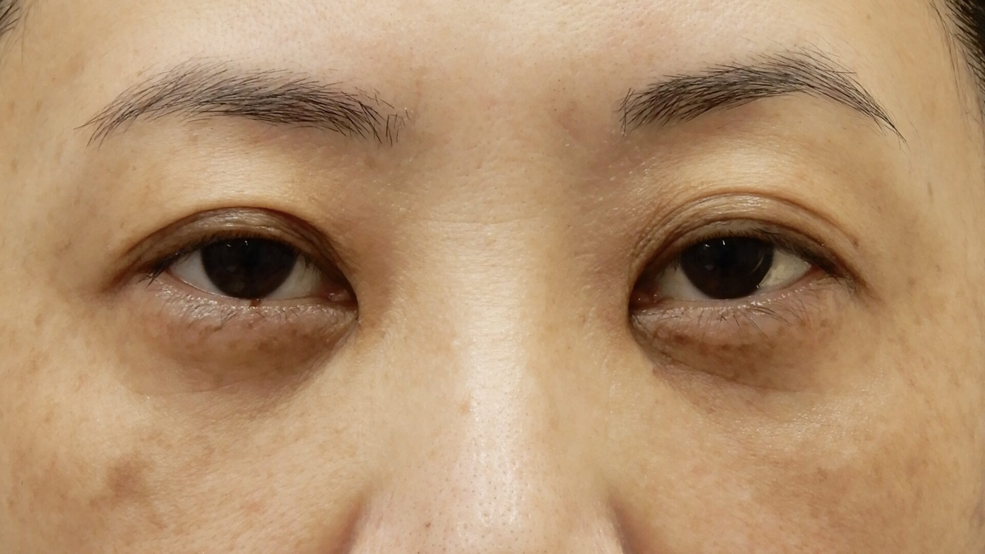 くまとりアフター