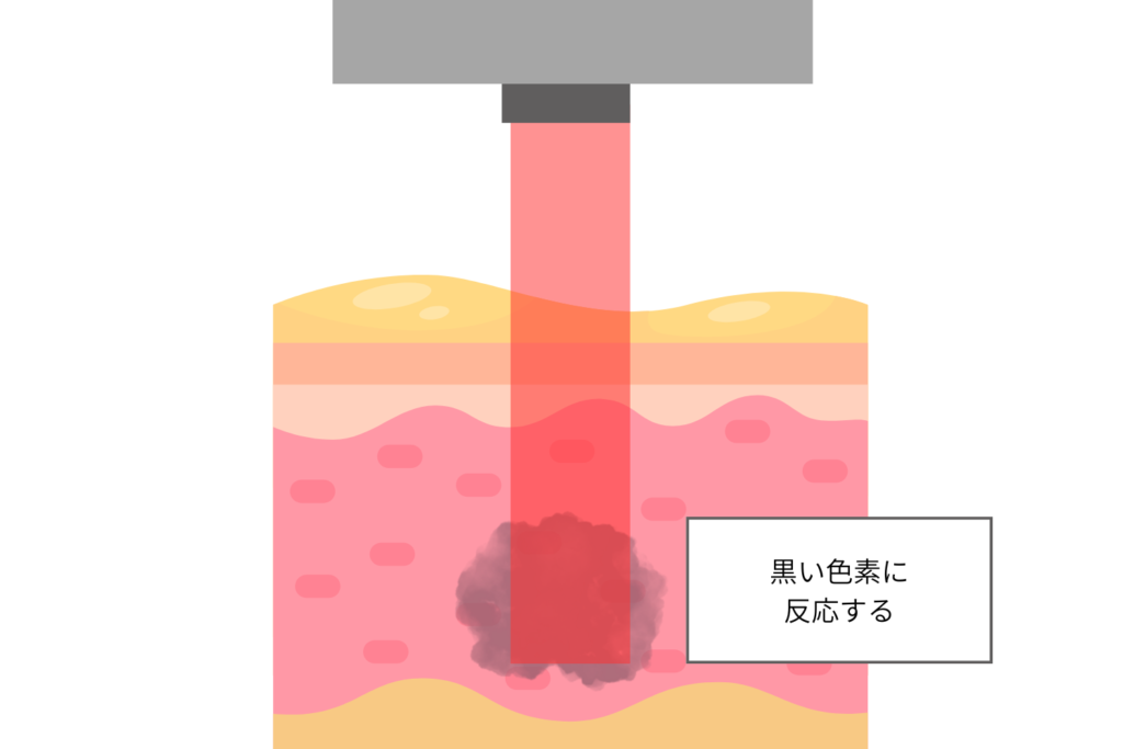 メラニン量が少ないとレーザーが反応しにくい理由