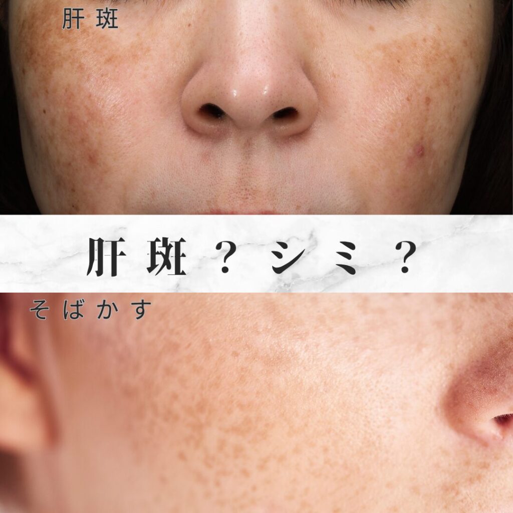 そばかすや肝斑との違い