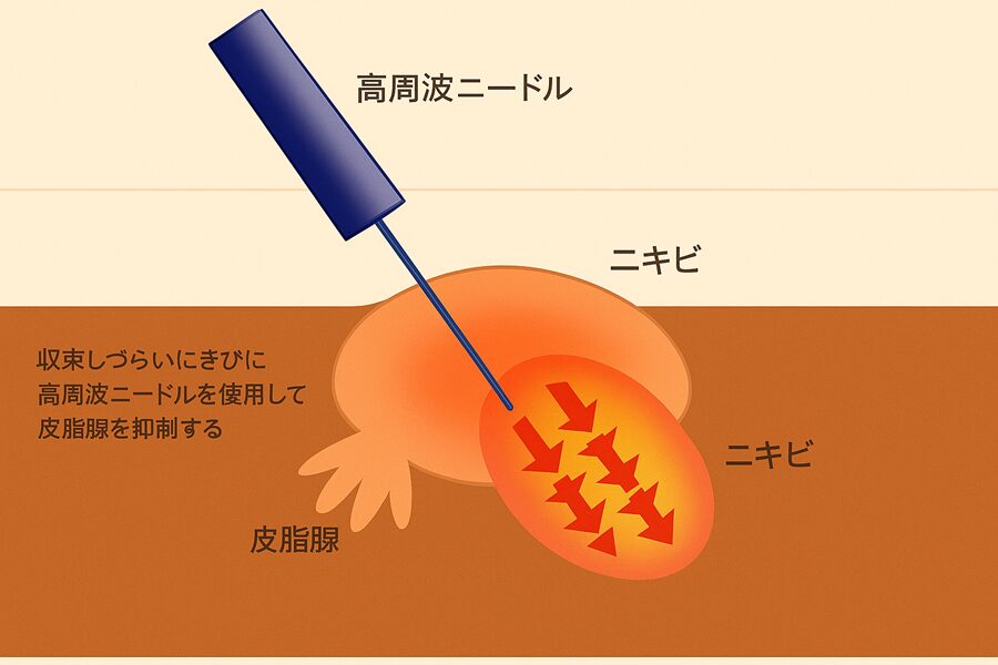 皮膚科で行う「面皰圧出(めんぽうあっしゅつ)」とは