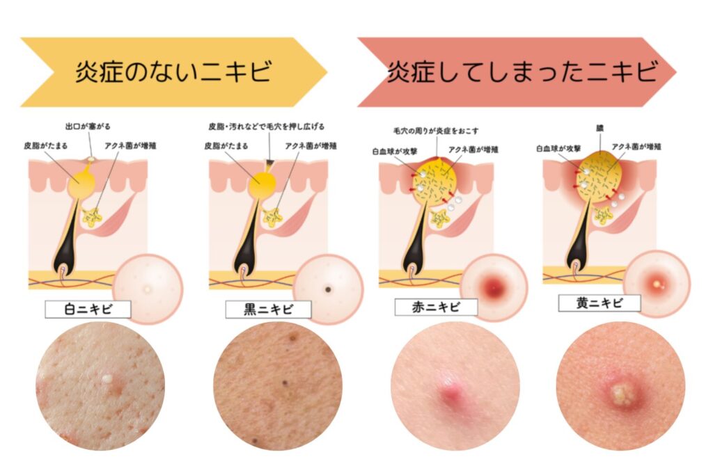 ニキビは進行段階で種類が変わる|見た目と痛みで見分けよう