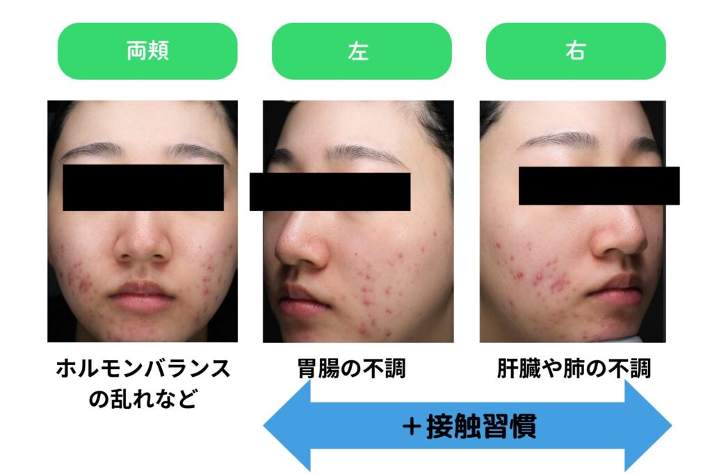 左右の頬で異なる原因