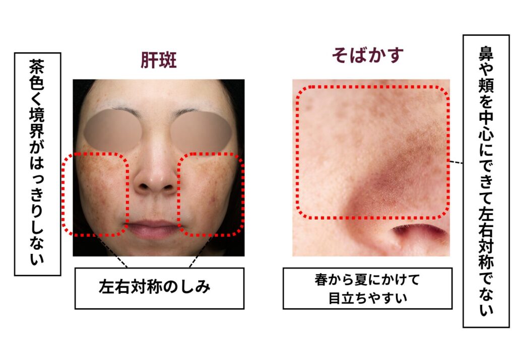 そばかすや後天性真皮メラノサイトーシスとの違い