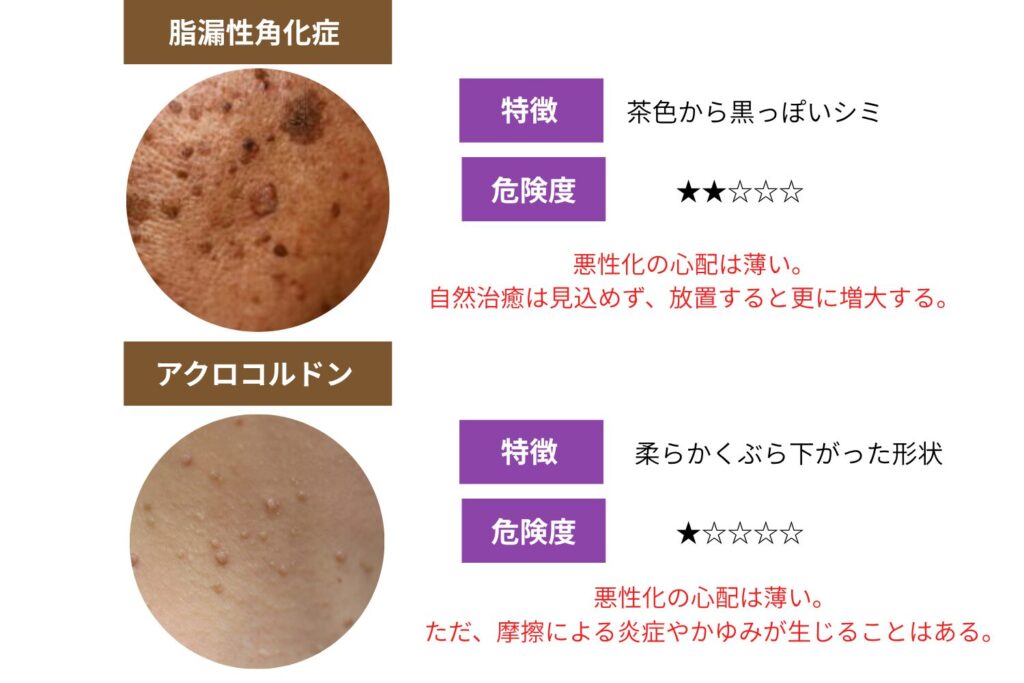 良性の盛り上がり：脂漏性角化症とアクロコルドン