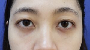 くま取り（30代・女性）アフター