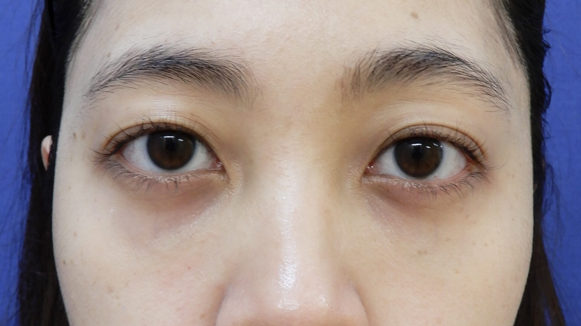 くま取り（30代・女性）アフター