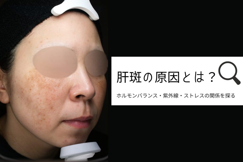 肝斑の原因とは？ホルモンバランス・紫外線・ストレスが関わるメ...