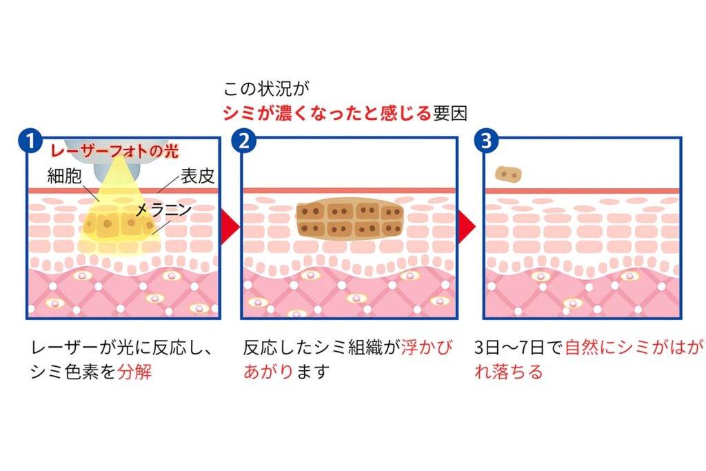 「シミが濃くなった」「取れなかった」と感じる原因を正しく理解しよう