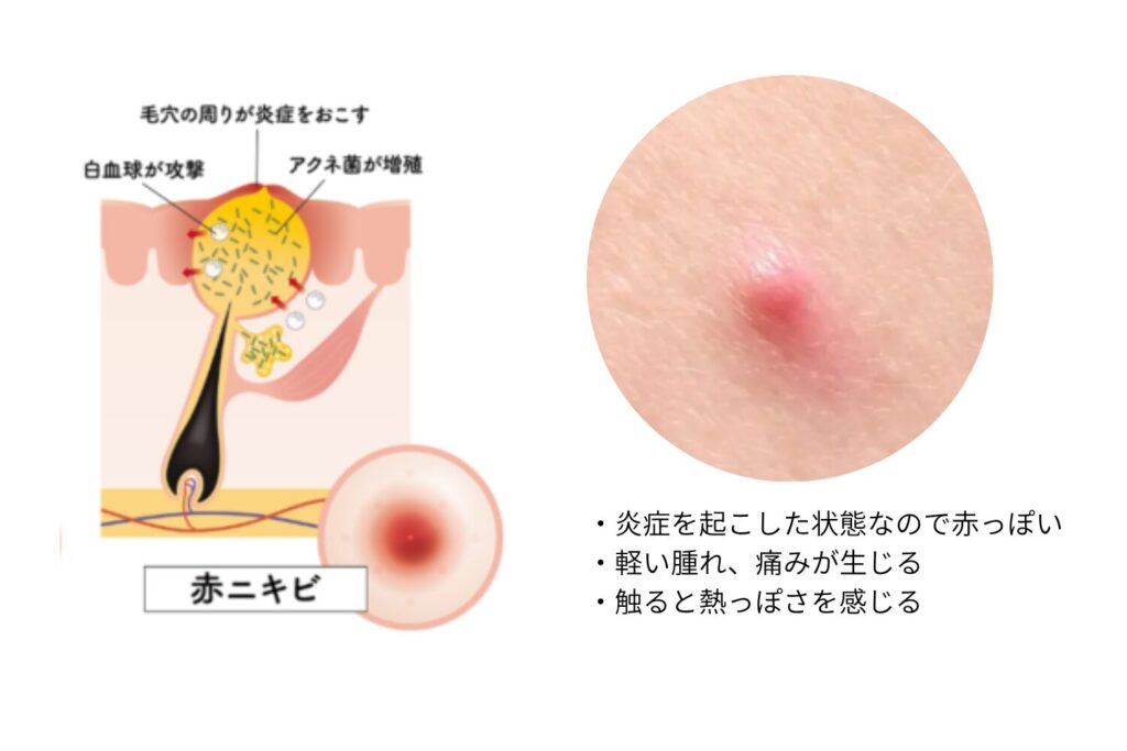 赤ニキビ:炎症の初期