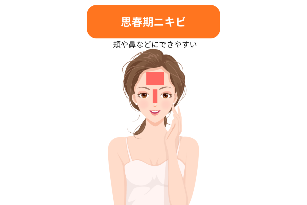 思春期ニキビ:Tゾーン中心で皮脂過剰が原因|清潔と油分対策を重視