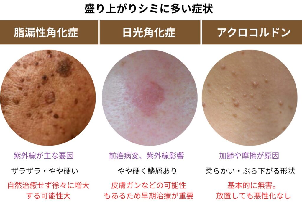 盛り上がるシミに多い疾患：脂漏性角化症・日光角化症・アクロコルドン