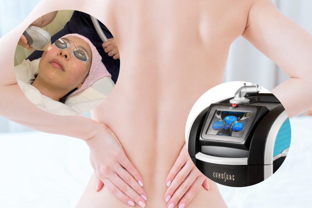 医療機器による背中のシミ治療