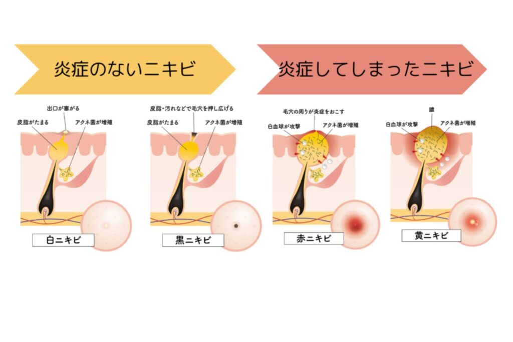 大人ニキビの種類