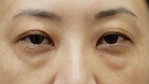 くまとりビフォー