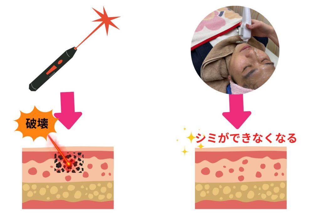 シミ取りはレーザーだけでない?