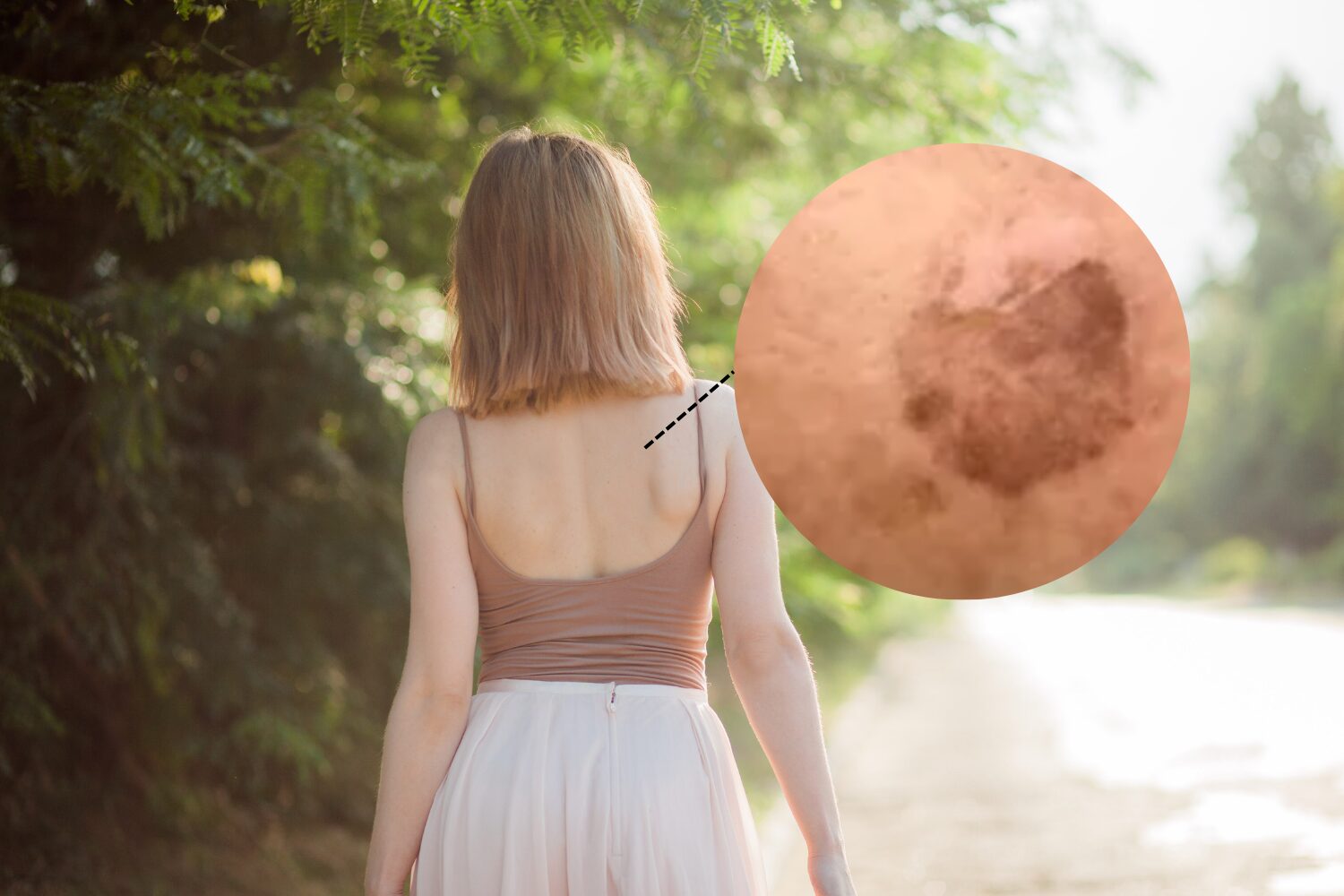 背中のシミ原因と消す方法|医師が教える正しい対策と治療法