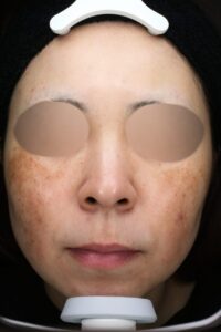 肝斑ビフォー