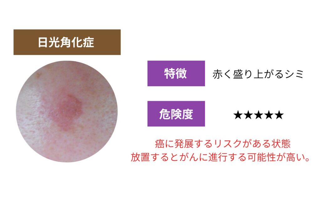 赤く盛り上がるシミの正体：日光角化症に注意